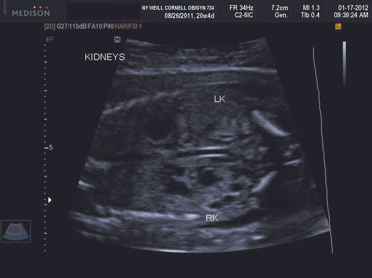 Second trimester unilateral multicystic dysplastic kidney