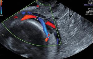 Transvaginal examination