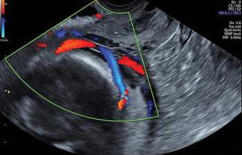 Transvaginal examination