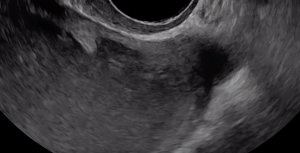 Normal vagina