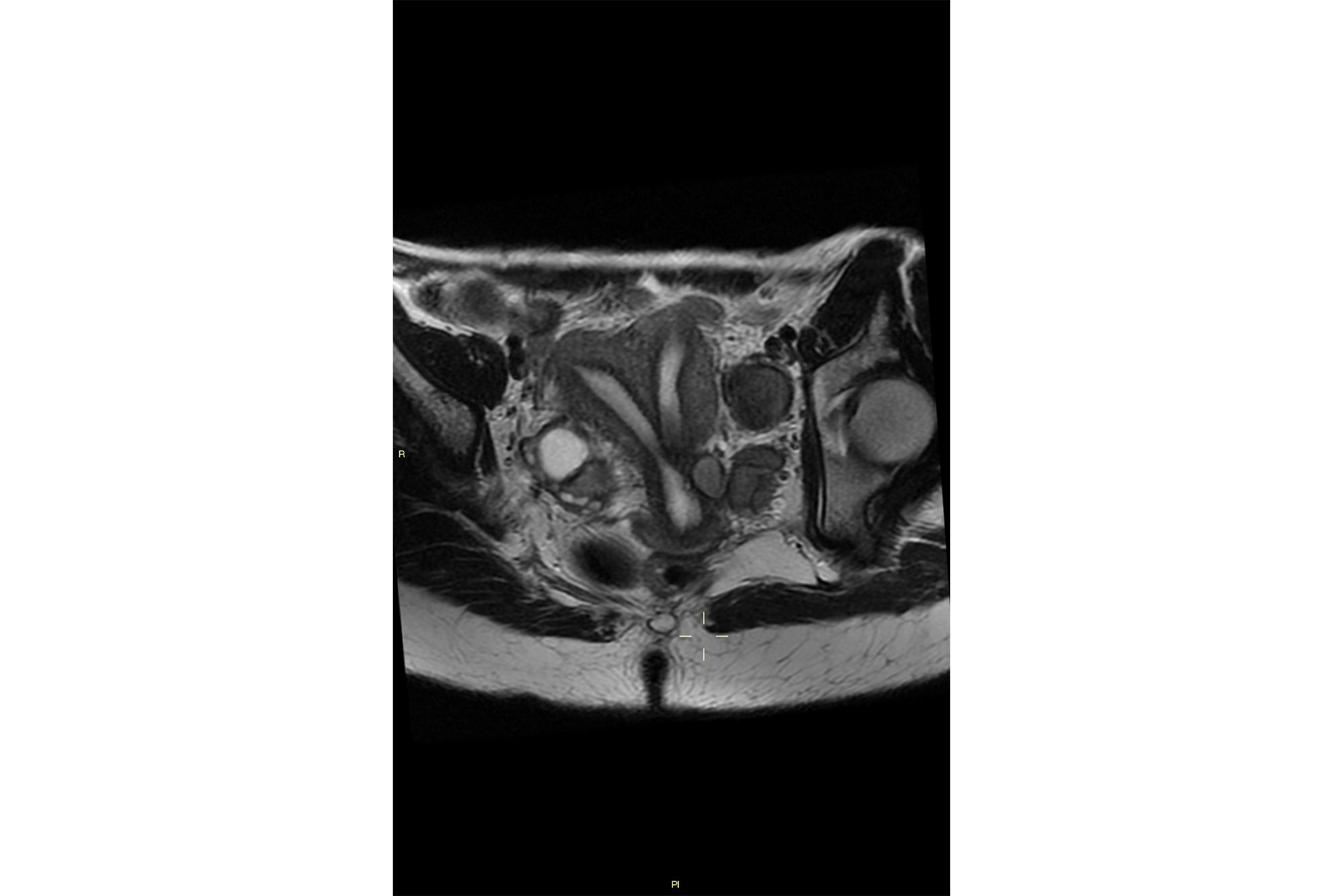Septate uterus long axis T2