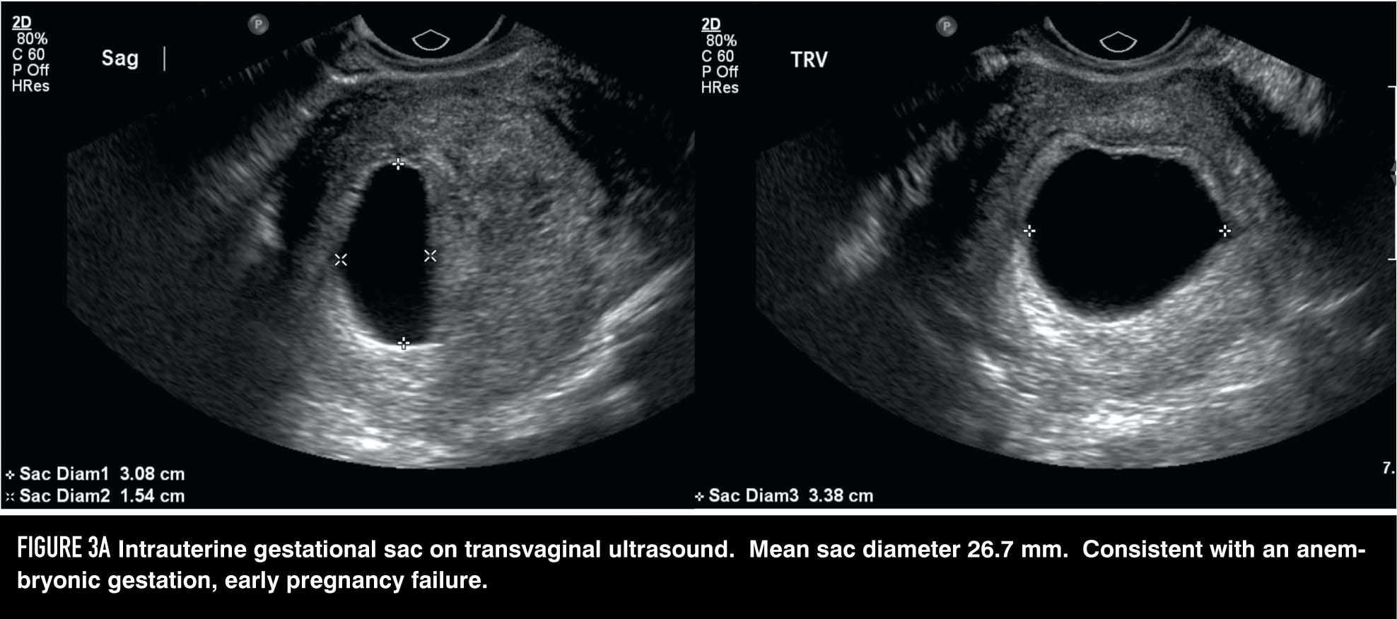 Анэмбриония на УЗИ 6 недель