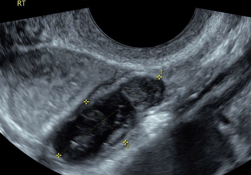 Ultrasound images: Gynecologic diagnoses (Part 2) | Contemporary OBGyn