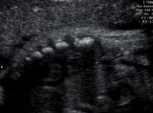 Sternum 3rd Trimester