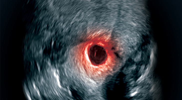 How To Diagnose And Treat Cesarean Scar Pregnancy How To Diagnose And Treat Cesarean Scar Pregnancy