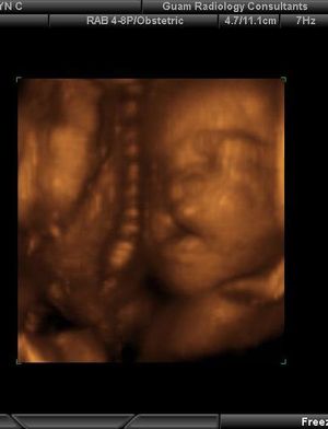Cleft Lip and Palate Still 4D surface rendered image