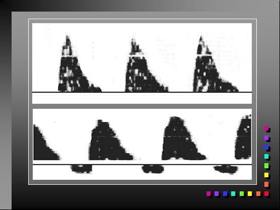 Doppler of the Uterine and Umbilical Arteries: Clinical Significance
