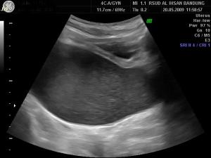 Hematometra Hymen Imperforated