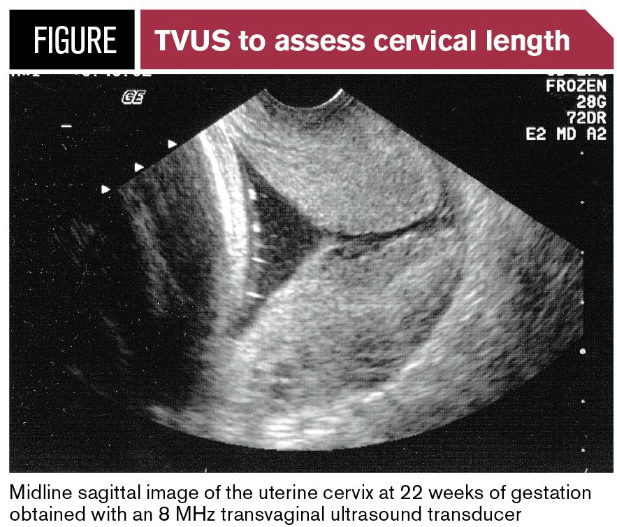 Universal or selective cervical length screening?