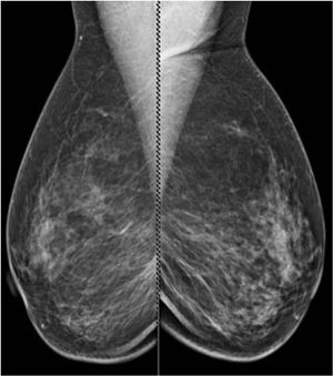 Ductal Carcinoma in Situ