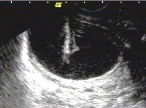 Transvaginal cyst aspiration