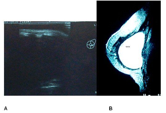 Evaluation of the Rupture of Silicone Breast Implants by Mammography