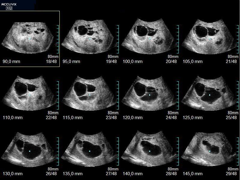 Ultrasound Interactive Case Study: Myoma