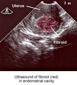 Diagnosis Of Uterine Fibroids Diagnosis Of Uterine Fibroids