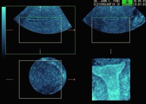 Multiplanar Reconstruction Proliferative Endometrium