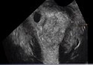 Diagnosis of Angular Pregnancy With 3D Ultrasound