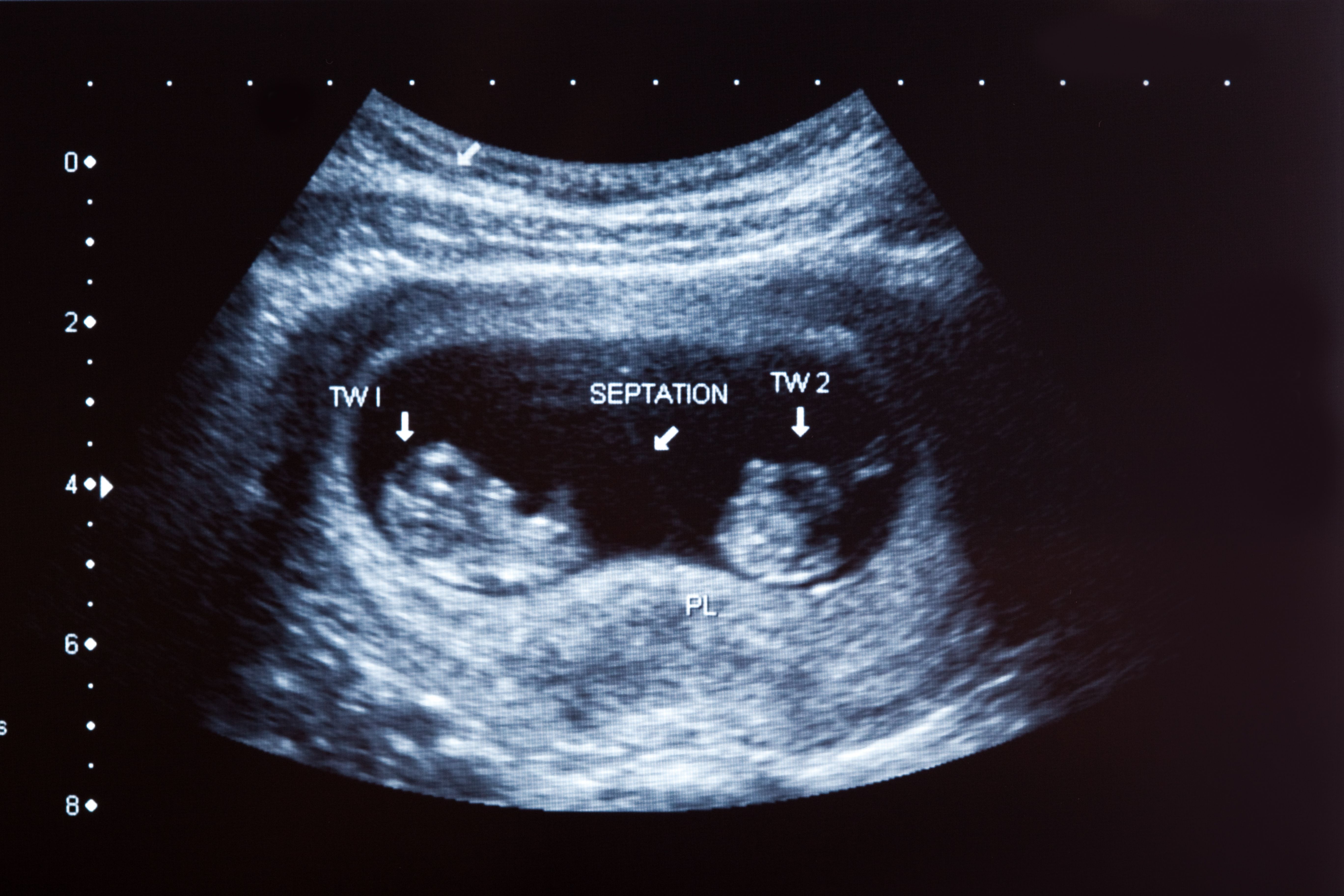 Беременность 12 4 недели. УЗИ 12 недель беременности двойня. УЗИ 10 недель беременности двойня. УЗИ 8 недель беременности двойня. УЗИ 20 недель беременности многоплодная беременность.