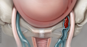 A simple step to reduce maternal death: Improve VTE prevention