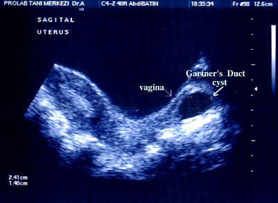 SAG Pelvis (Transabdominal) Gartner's Duct Cyst SAG Pelvis (Transabdominal) Gartner's Duct Cyst