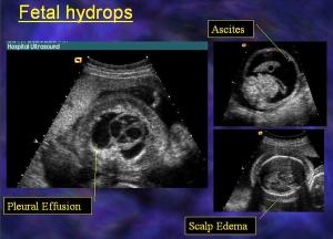 TRV Chest, Abdomen, Head Hydrops Fetalis