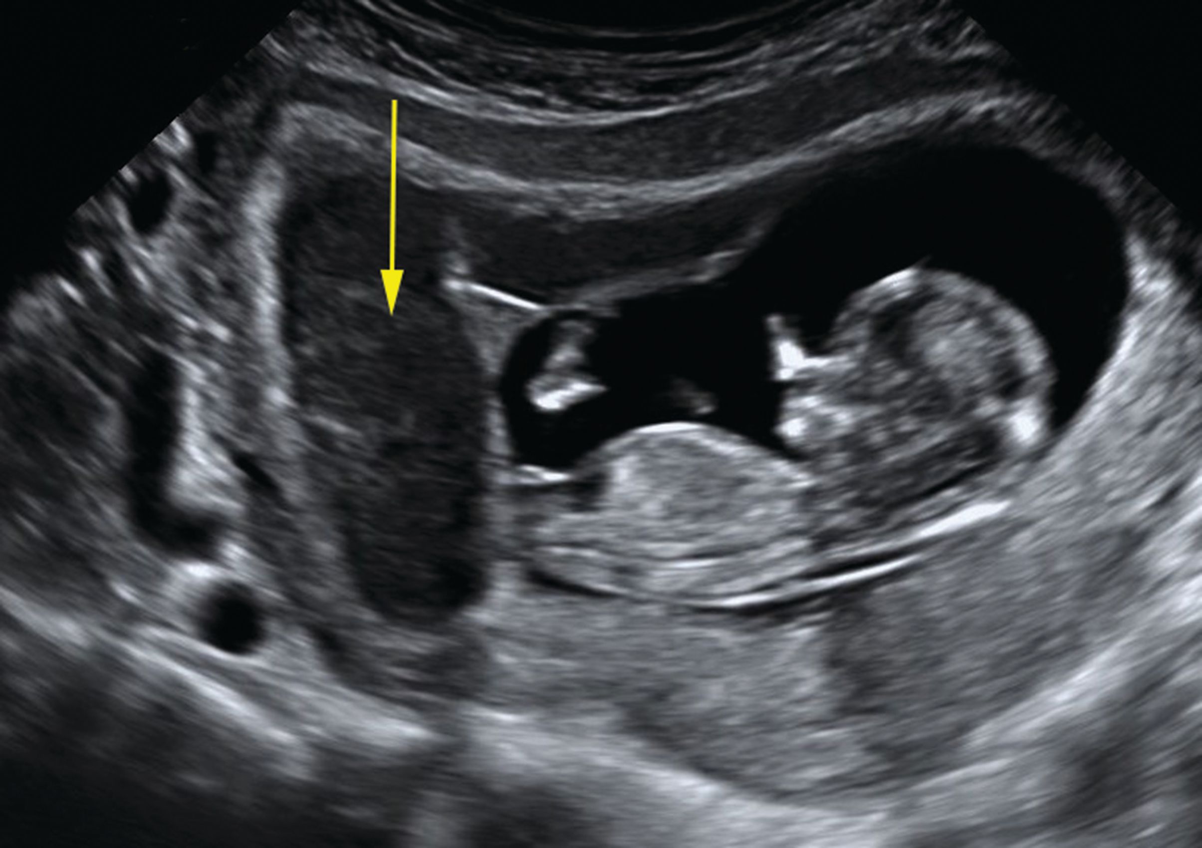 An imaging approach to early pregnancy failure | Contemporary OB/GYN, image size:2409x1700