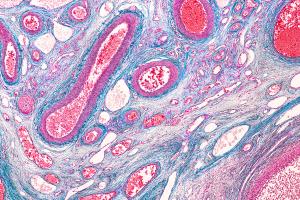 Frequent use of neoadjuvant chemotherapy may further benefit patients with advanced ovarian cancer