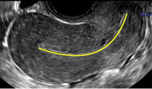 Tackling The Difficult Iud Insertion Tackling The Difficult Iud Insertion