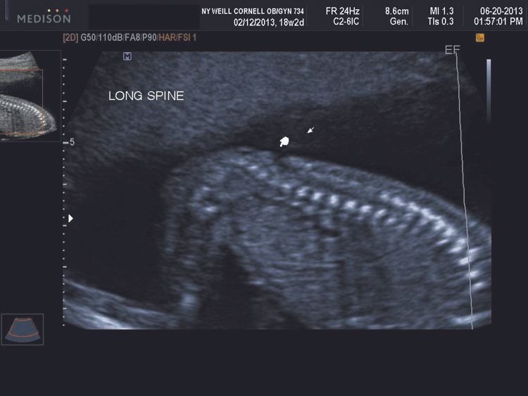 Second trimester lumbosacral spina bifida sagittal