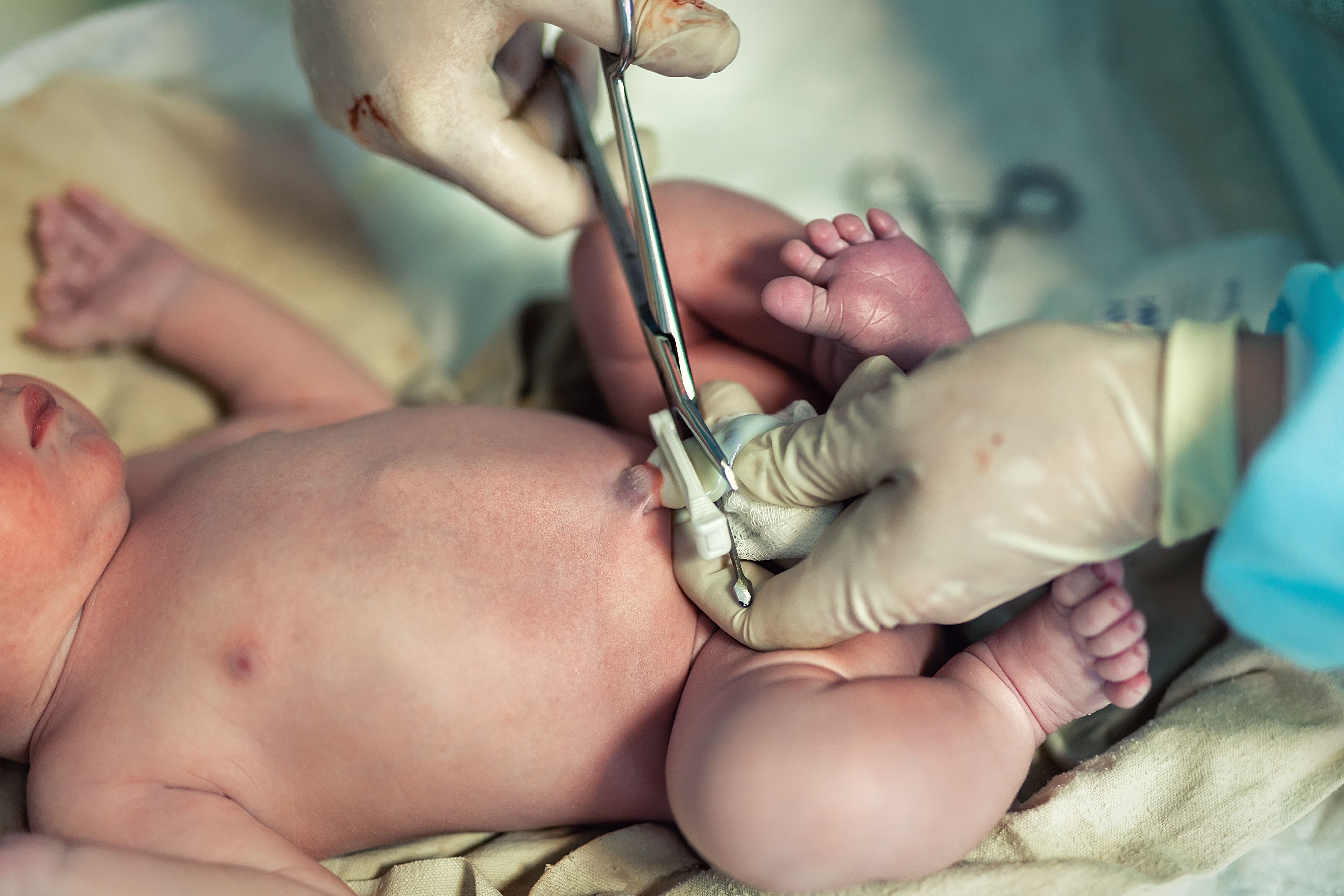 ACOG updates clinical guidance on delayed umbilical cord clamping in preterm neonates ACOG updates clinical guidance on delayed umbilical cord clamping in preterm neonates