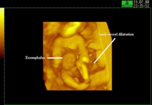 3D Surface Reconstruction Omphalocele