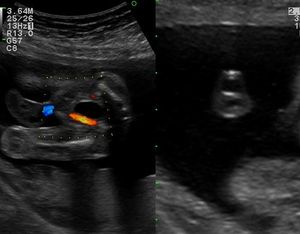 Single Umbilical Artery Color Doppler