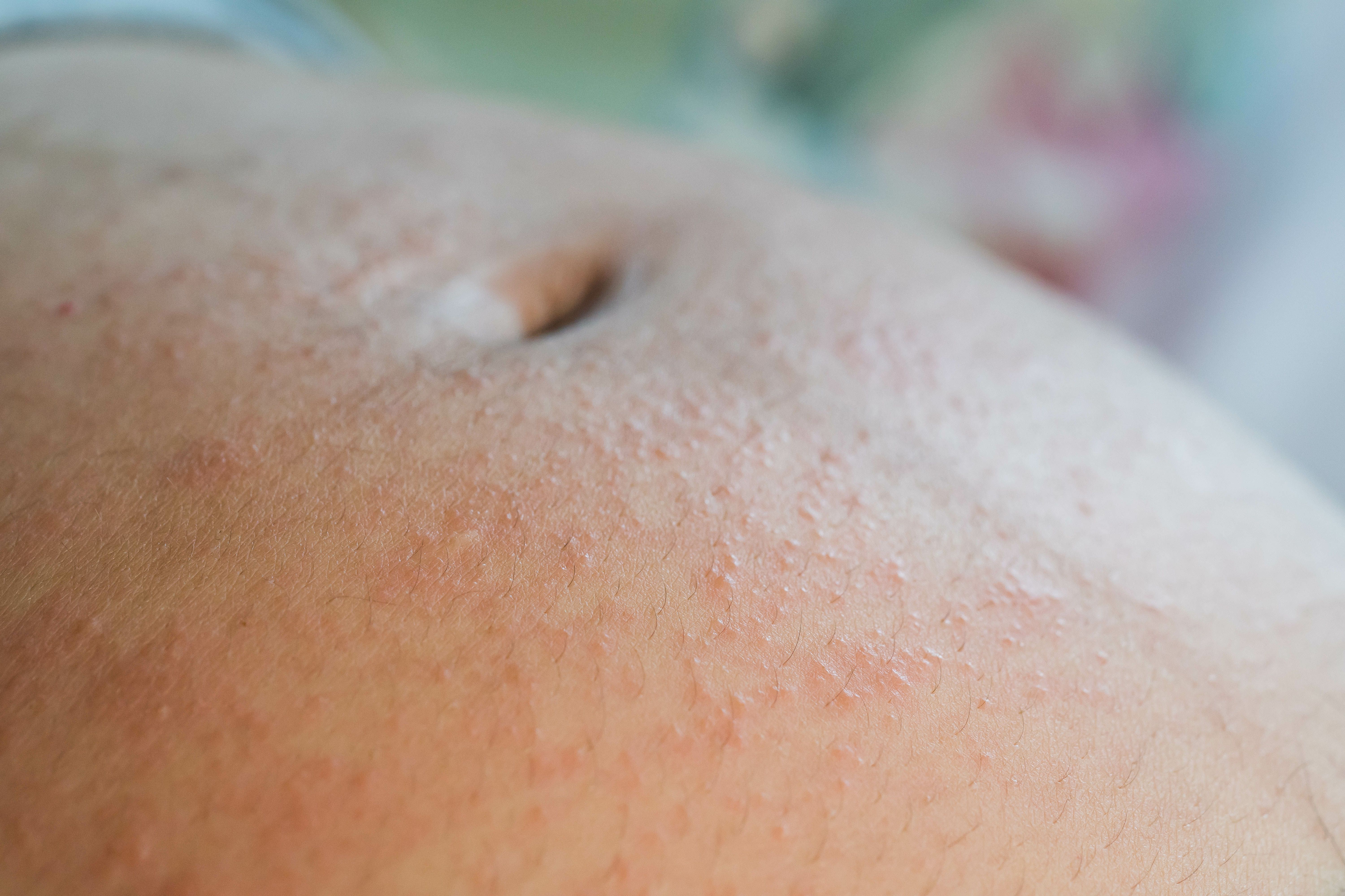 Dermatitis During Pregnancy