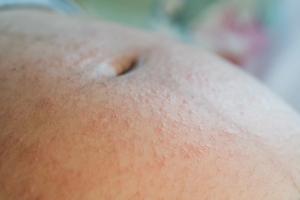 Dermatoses of Pregnancy