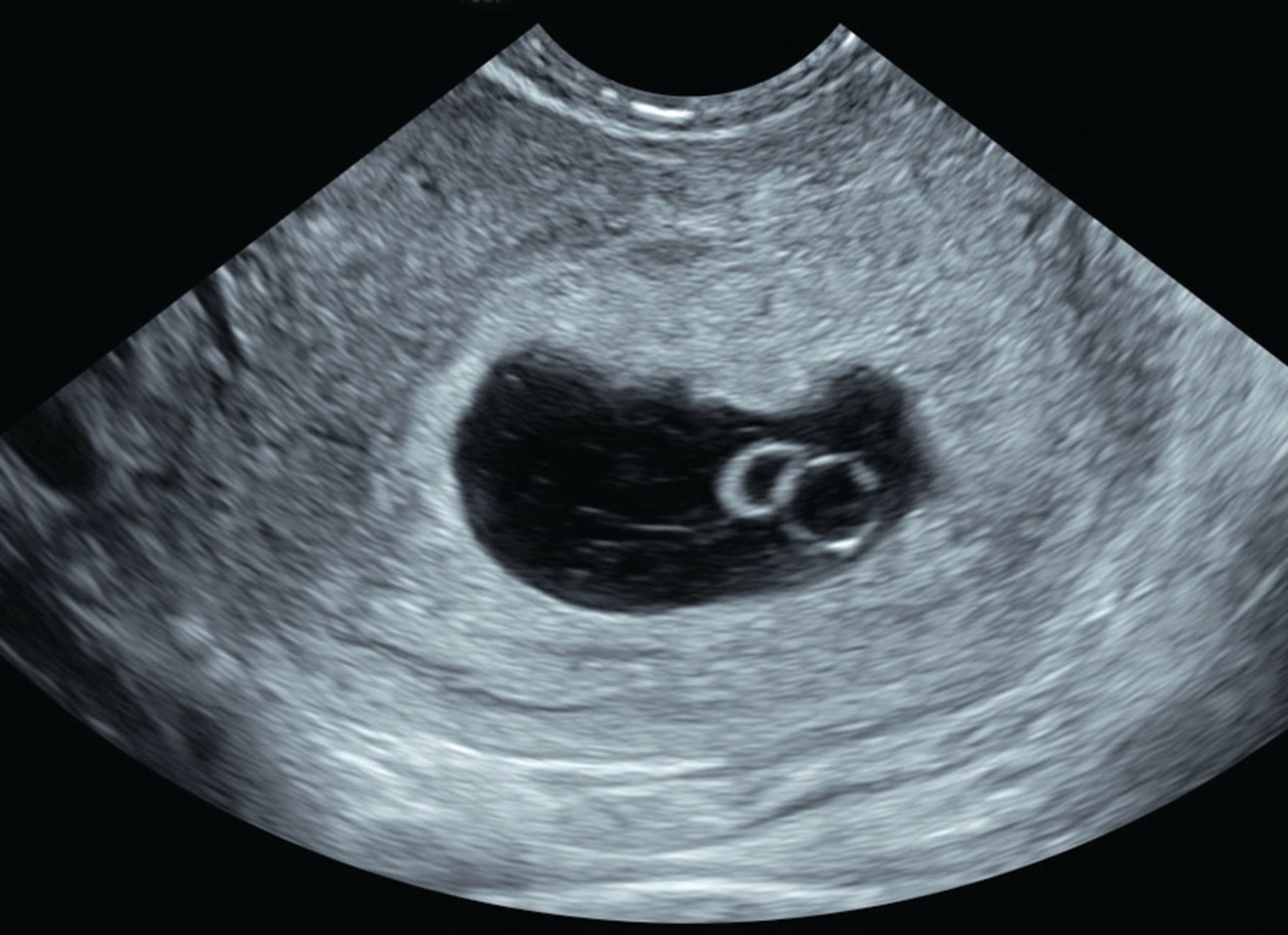 6 on week what ultrasound see should a you 6 week