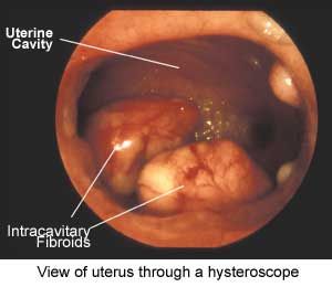 Diagnosis Of Uterine Fibroids Diagnosis Of Uterine Fibroids