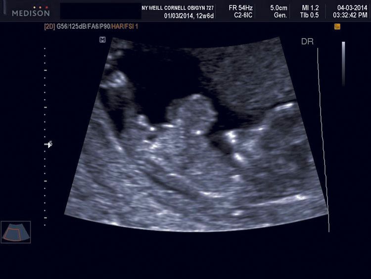 First trimester omphalocele