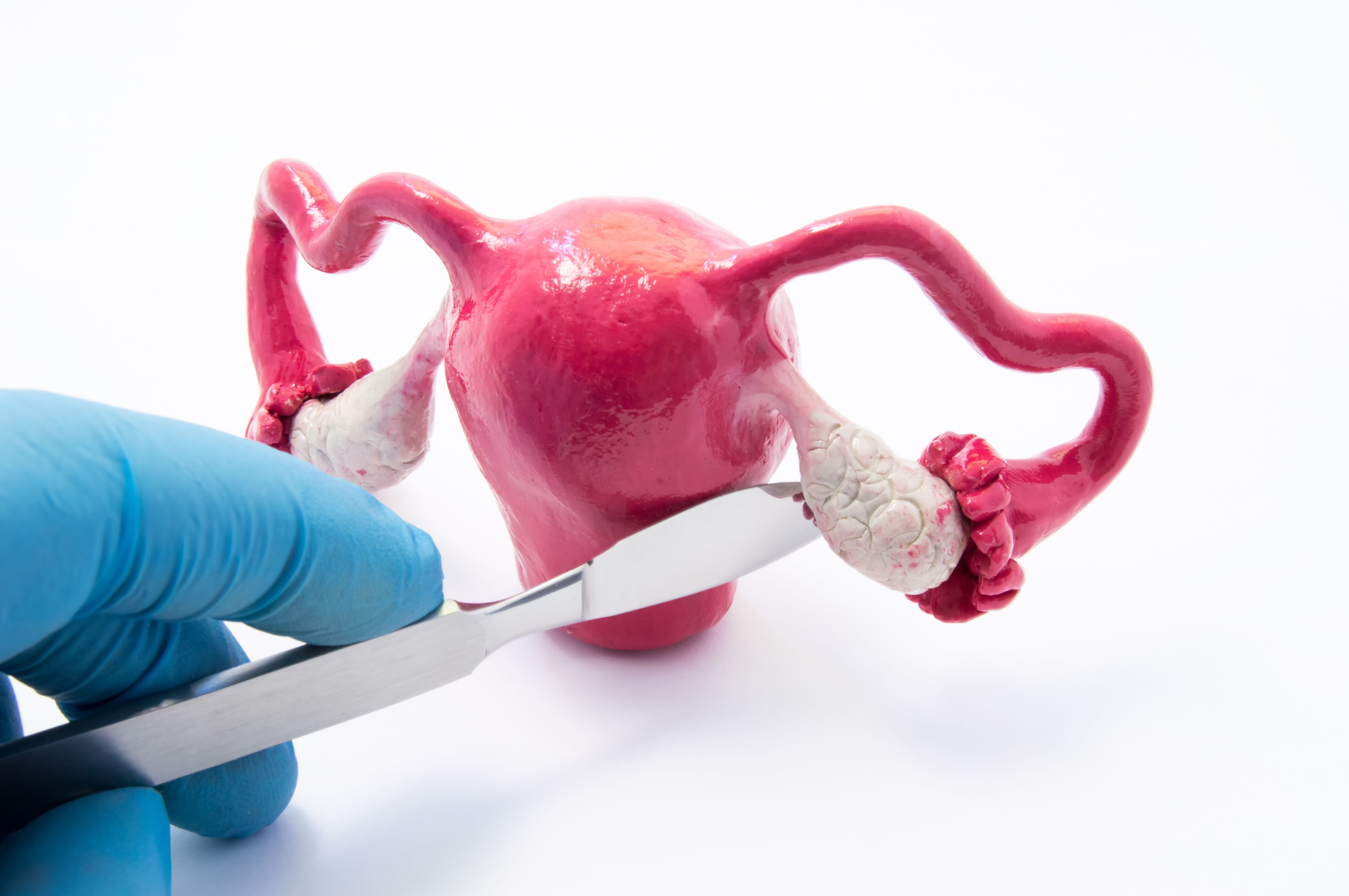 Salping Effects of risk-reducing salpingo-oophorectomy on sexual functioning