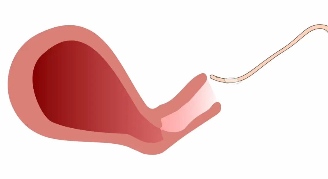 A simple, life-saving innovation: Using a foley catheter for uterine suction and hemorrhage control | Image Credit: Frank Jackson, DO