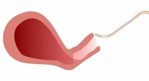 A simple, life-saving innovation: Using a foley catheter for uterine suction and hemorrhage control | Image Credit: Frank Jackson, DO