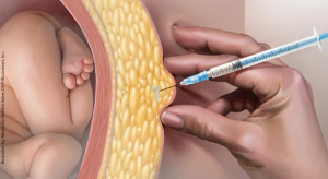 Using oral antidiabetic agents to manage hyperglycemia in GDM