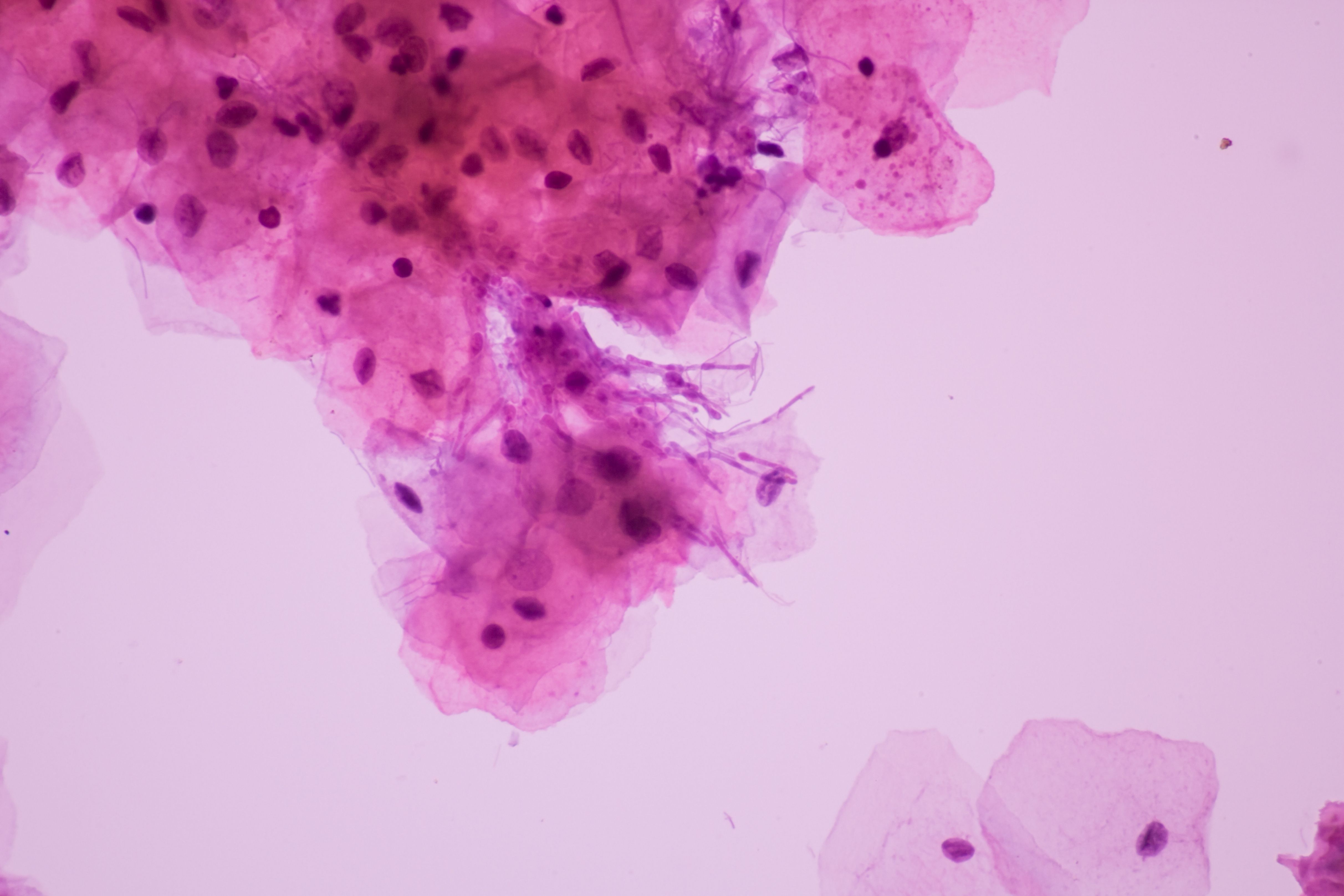 Recurrent Vvc Risks for recurrent VVC caused by non-albicans candida vs candida albicans