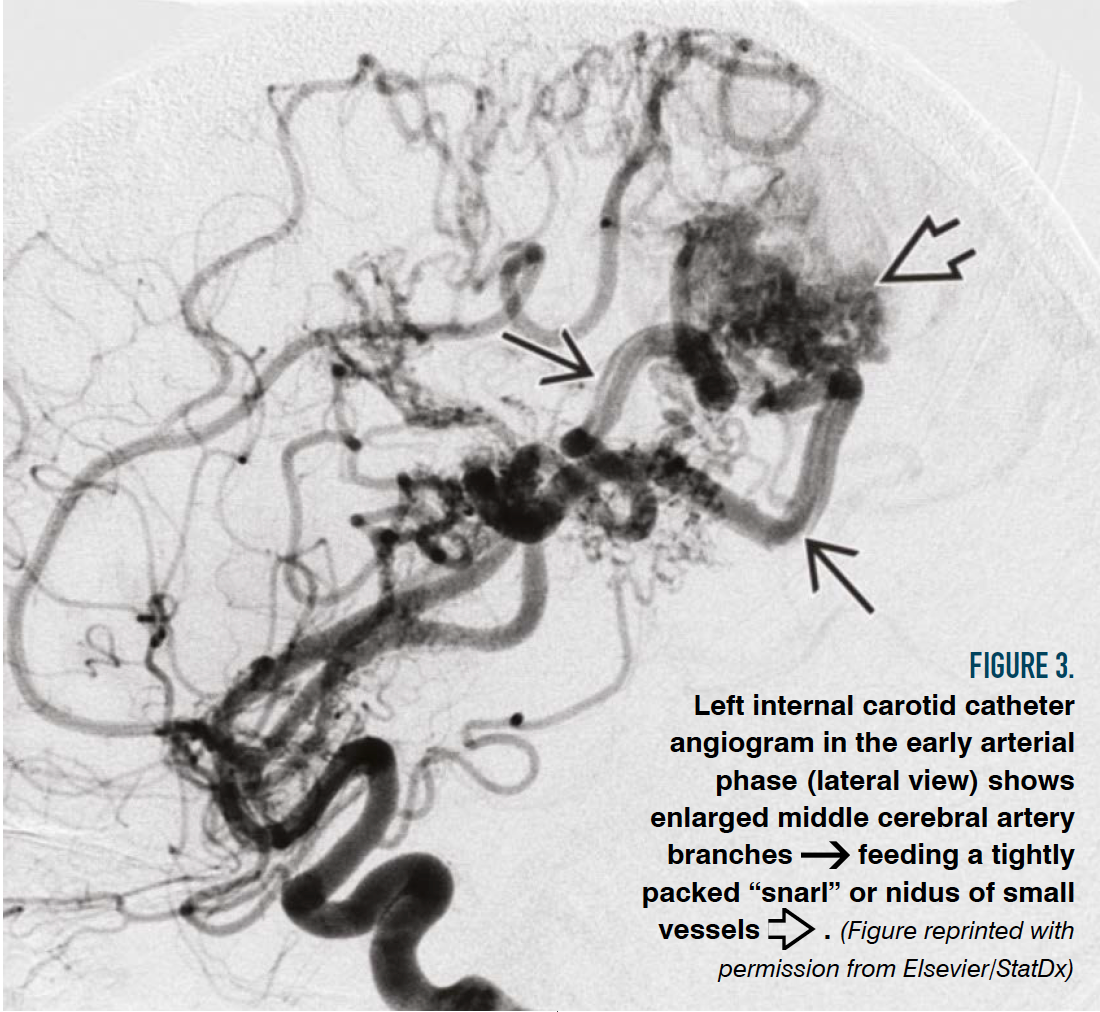 Figure 3.

Left internal carotid catheter angiogram in the early arterial phase (lateral view) shows enlarged middle cerebral artery branches feeding a tightly packed “snarl” or nidus of small vessels . (Figure reprinted with permission from Elsevier/StatDx)