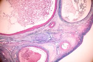 Perimenopausal abnormal uterine bleeding