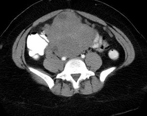 Endometrial Stromal Sarcoma