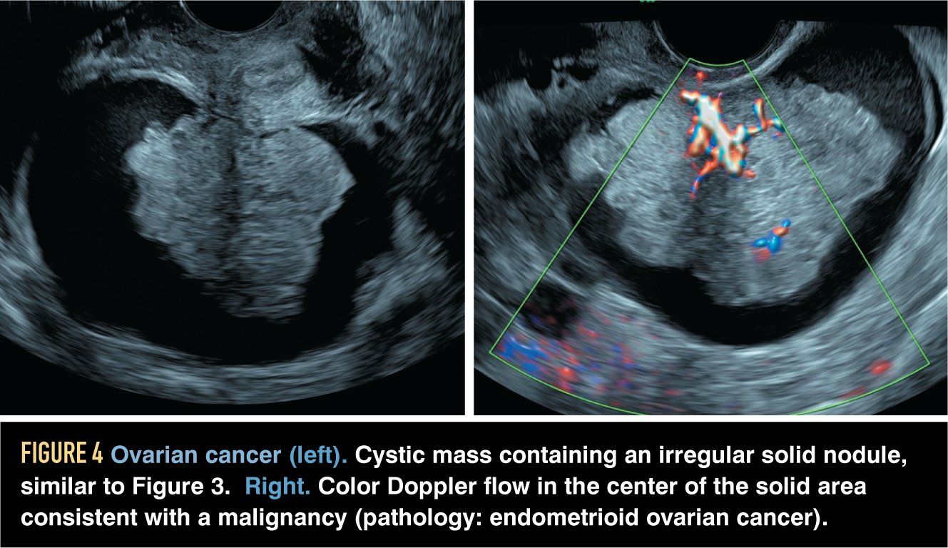 Ovarian Cancer Ultrasound Of Ovaries With Cyst : Sonographic Assessment ...