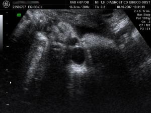 Dacriocistocele, congenital cyst of the nasolacrimal duct