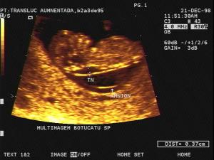 LONG Fetus Increased Nuchal Translucency