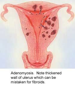 Diagnosis Of Uterine Fibroids Diagnosis Of Uterine Fibroids
