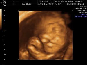 Cleft of the lip 4D still image