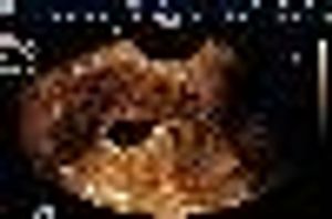 SAG Uterus (Transvaginal) Endometrial Polyp